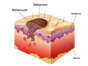 melanomsferamedija