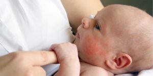 atopijski_dermatitis_prepoznavanje_znakovi
